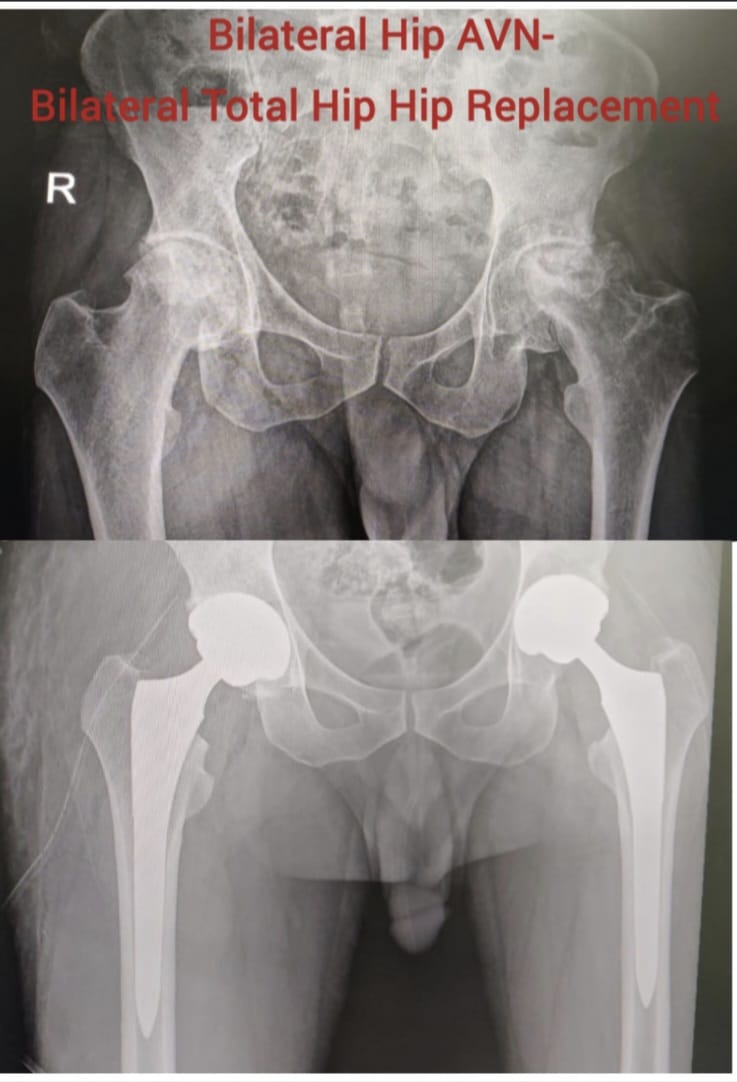 Primary total hip replacement